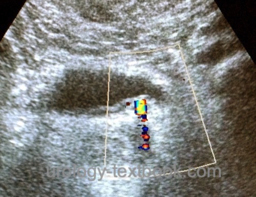 figure Twinkling artifact caused by a distal ureteral calculi. 