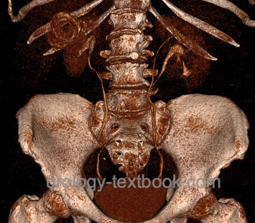 figure CT of a left-sided ureteral duplication