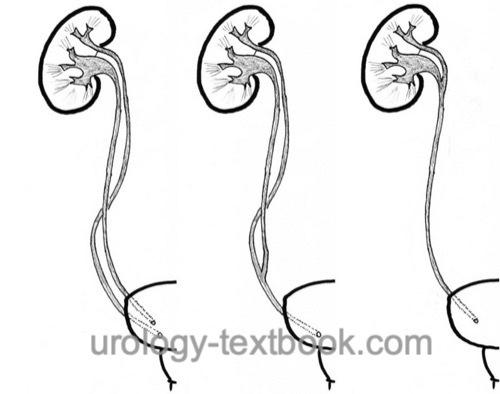 figure variants of the duplex kidney bifid ureter ureteral duplication ureteral triplication