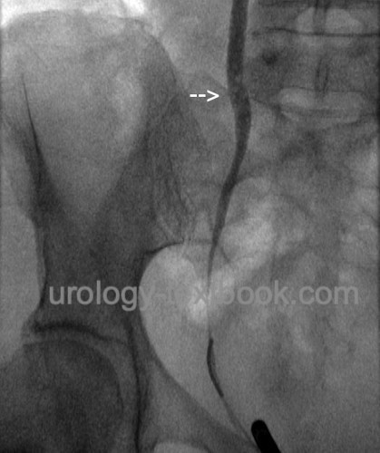 fig. retrograde pyelography of ureteritis cystica
