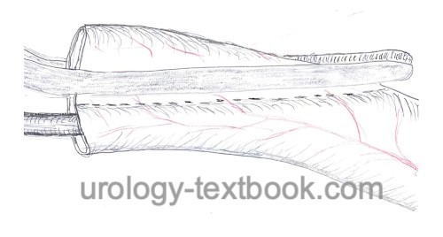 figure Ureter remodeling before ureterocystoneostomy: Excisional tapering