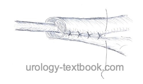 figure Ureter remodeling before ureterocystoneostomy: plication technique