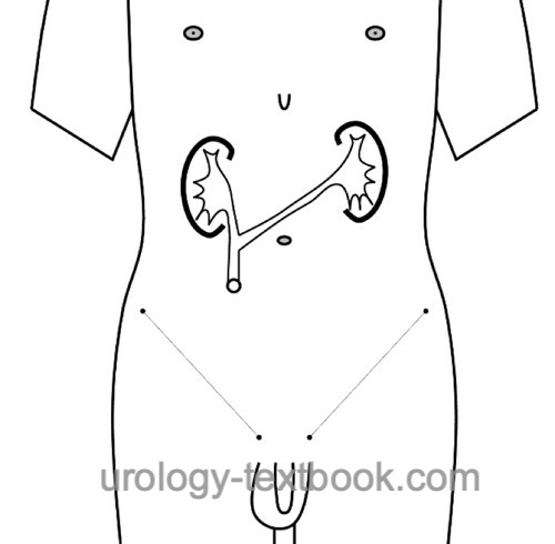 figure ureterocutaneostomy: the shorter ureter is anastomosed end-to-side to the longer ureter, which is passed through the abdominal wall.