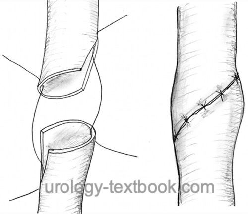 fig. ureteroureterostomy: end-to-end ureter anastomosis 