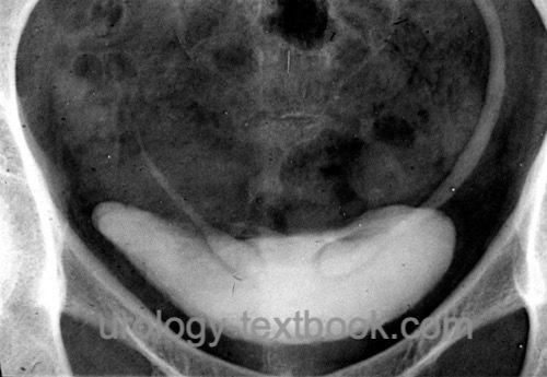 figure Bilateral cobra head sign in intravenous urography