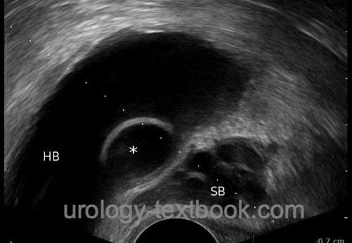 figure Transrectal ultrasound imaging of a ureterocele