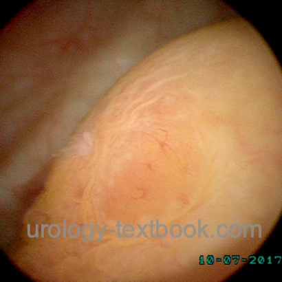 figure cystoscopy of a small ureterocele with a stone