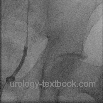 figure retrograde pyelography of a small ureterocele with a stone