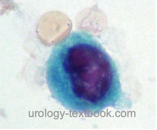 figure: urine cytology with high-grade tumor cell