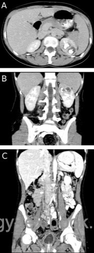 figure ct scan of urogenital tuberculosis