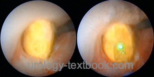 figure Ureterorenoscopy: ureteral stone disintegration with a holmium laser