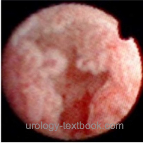 figure Atlas of Ureteroscopy Findings Flexible URS: papillary renal calyceal carcinoma.