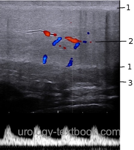 figure penile Doppler ultrasonography after intracavernous injection of alprostadil