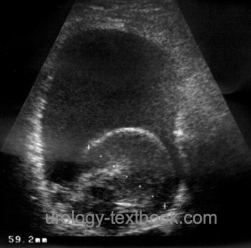 fig. CT of an intraperitoneal bladder rupture injury