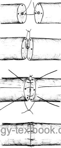 figure Vasovasostomy technique