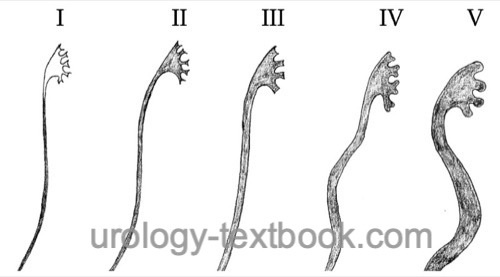 figure Classification of vesicoureteral reflux