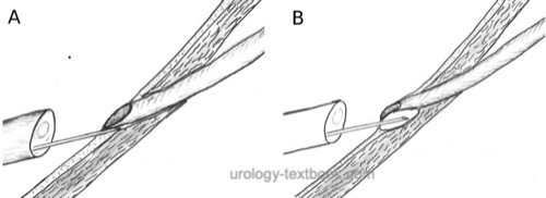 figure Endoscopic treatment of vesicoureteral reflux