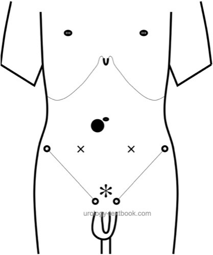 Figure Trocar positions for laparoscopic pelvic lymphadenectomy