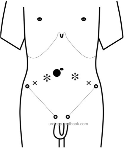 Figure Trocar positions for laparoscopic radical prostatectomy