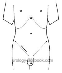 fig. inguinal incision: surgical approach to the inguinal canal