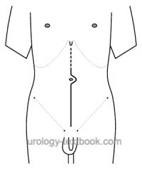 fig. skin incision for a midline laparotomy