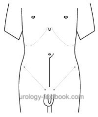 fig. lower midline incision