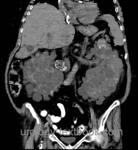 Abb. CT Abdomen in ADPKD